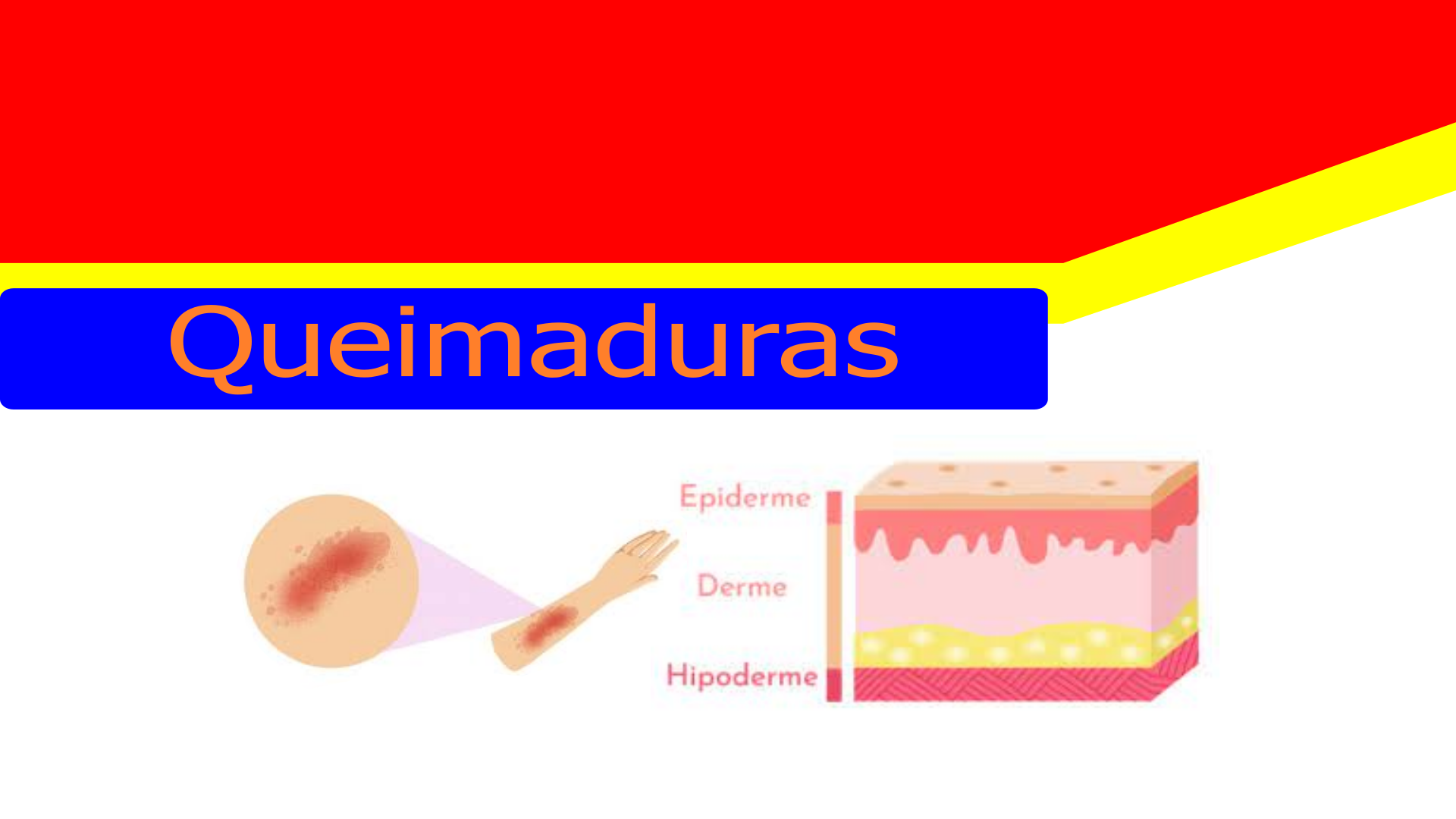 Tipos de Queimaduras e o que fazer